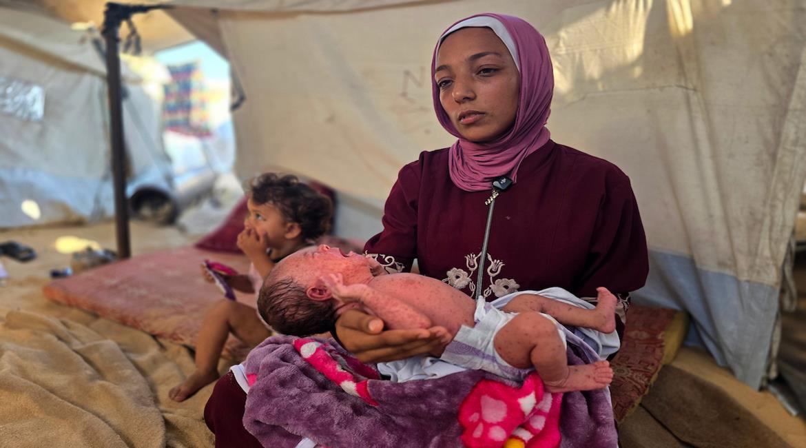 أطفال تظهر عليهم أعراض يُشتبه بأنها مرتبطة بجدري الماء في خان يونس جنوب قطاع غزة، في ظل تحذيرات صحية من تزايد الحالات بين النازحين بسبب الاكتظاظ ونقص المياه النظيفة وتدهور خدمات الصرف الصحي