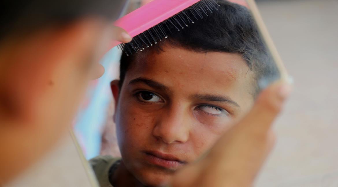 الطفل محمد الجرجاوي، البالغ من العمر اثنتي عشرة سنة، فقد إحدى عينيه جراء اعتداء جندي إسرائيلي عليه أثناء هروبه من شمال قطاع غزة، يعيش داخل خيمة في ظروف صعبة مع عائلته في مدينة غزة