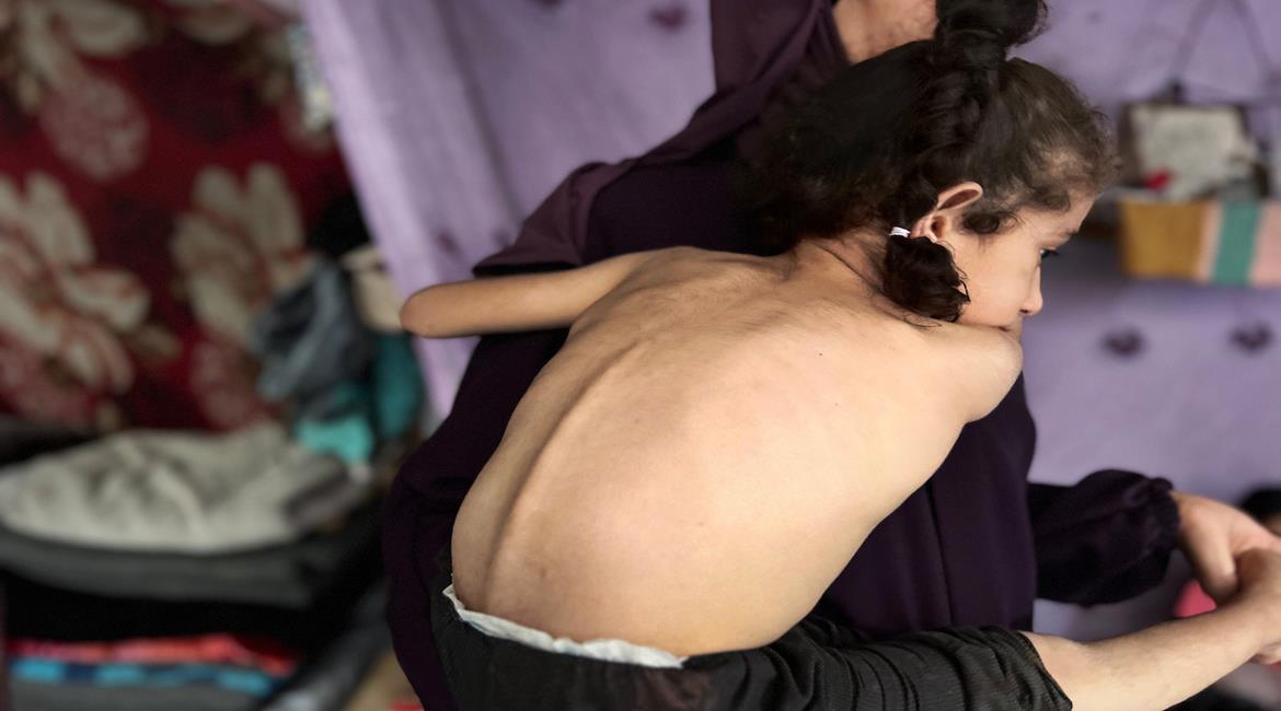    الطفلة الفلسطينية داليا الزويدي (5 أعوام) تتلقى الرعاية من والدتها داخل خيمة في مخيم النصيرات وسط قطاع غزة، حيث تعاني من نقص في الأكسجين بالدماغ أفقدها القدرة على الوقوف أو الحركة،